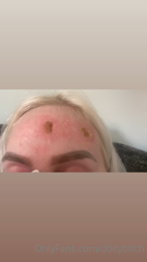 163465810_laser-on-forehead-update-as-you-can-see-my-forehead-is-l_0.m4v